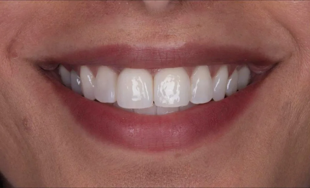 receding gums