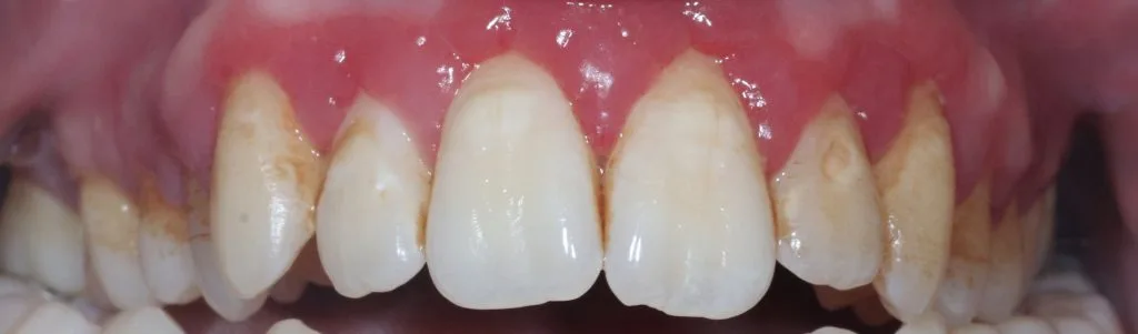 gum disease treatment