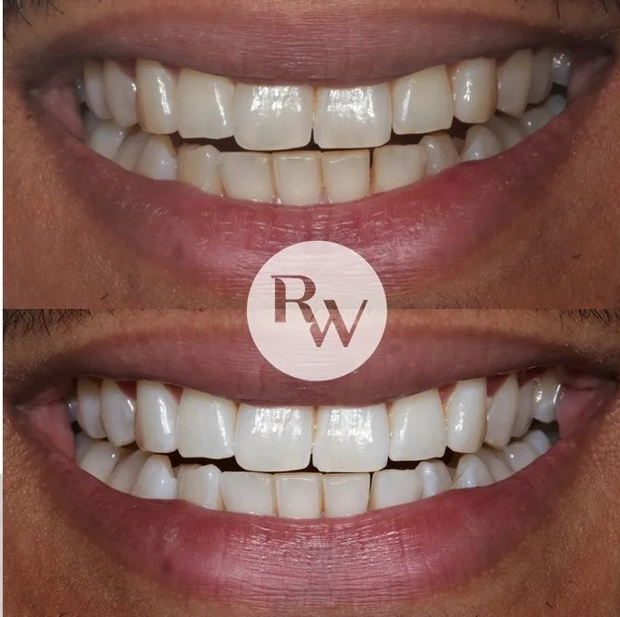 polish and perfect teeth cleaning, periodontist london